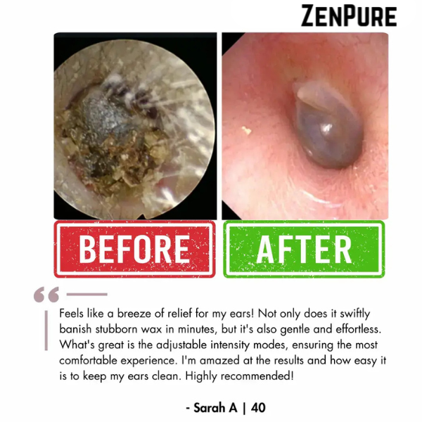 ZenPure™ Electric Ear Wax Removal Kit