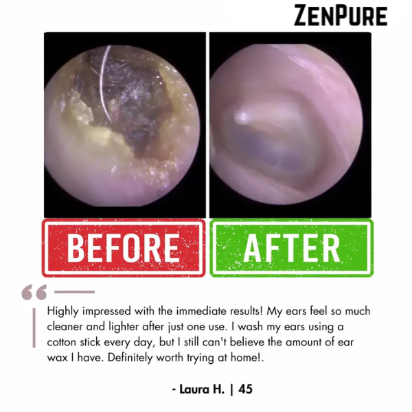 ZenPure™ Electric Ear Wax Removal Kit